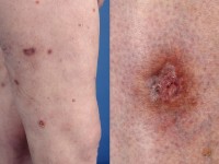 Lymfocytaire vasculitis