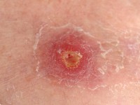 Lymfocytaire vasculitis