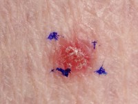 Lymfocytaire vasculitis