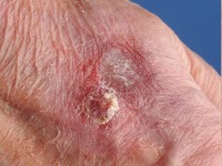 Lymfocytaire vasculitis