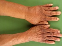 Lymphedema of the arm