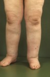 Lymphedema