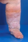 Lymphedema