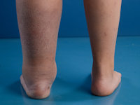 Primair lymfoedeem type Milroy