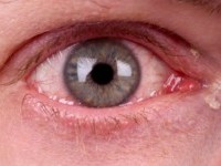 LDS (lymphoedema distichiasis syndroom)