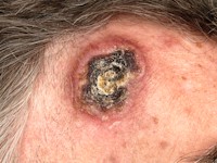 Lymphomatoide granulomatosis