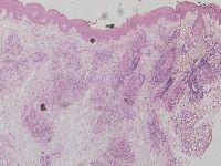 Lymfomatoïde lupus erythematosus