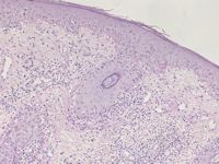 Lymfomatoïde lupus erythematosus