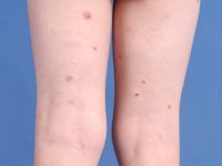 Lymfomatoïde papulose