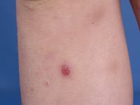 Lymfomatoïde papulose