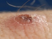 Lymfomatoïde papulose