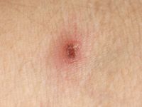 Lymfomatoïde papulose