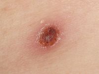 Lymfomatoïde papulose