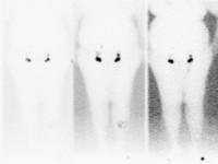 Lymfeklierscintigrafie