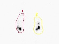 Lymfeklierscintigrafie