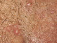 Lymphangioma circumscripta