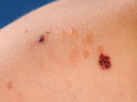 Lymphangioma circumscripta