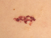 Lymphangioma circumscripta