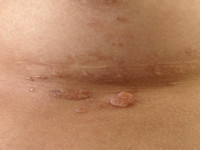 Lymphangioma circumscripta