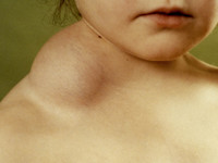 Lymphangioma circumscripta