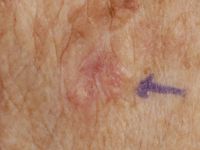 Lymphoepithelioma-like carcinoma of the skin