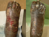 Maceratio cutis, immersion foot