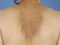 Amyloidosis cutis maculosa