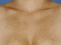 Amyloidosis cutis maculosa