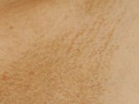 Amyloidosis cutis maculosa