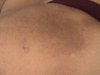 Amyloidosis cutis maculosa