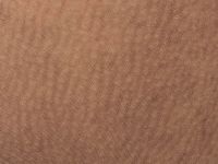 Amyloidosis cutis maculosa