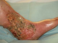 Maden in een ulcus curis