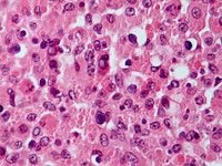 Michaelis-Gutmann bodies bij malakoplakia