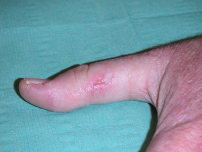 porcelein witte beschadigingen bij papulosis atrophicans maligna van Degos