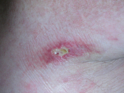 porcelein witte beschadigingen bij papulosis atrophicans maligna van Degos