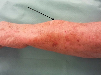 Malignant fibrous histiocytoma, deep