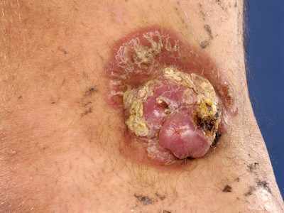 Malignant fibrous histiocytoma, superficial