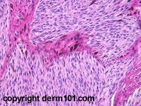 Blue cellular neuronevus van Masson