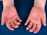 Mechanic hands als uiting van het antisynthetase syndroom