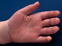 Mechanic hands als uiting van het antisynthetase syndroom