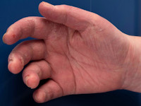 Mechanic hands als uiting van het antisynthetase syndroom