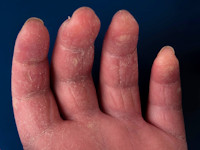 Mechanic hands als uiting van het antisynthetase syndroom