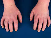 Mechanic hands als uiting van het antisynthetase syndroom