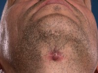 Thyreoglossal duct cyste