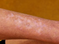 Melanoma associated leukoderma