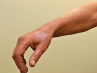 Melanoma associated leukoderma