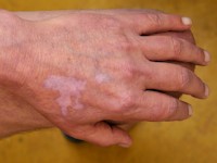 Melanoma associated leukoderma