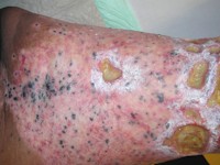 Melanoma associated leukoderma