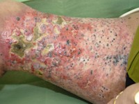 Melanoma associated leukoderma