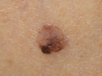 Melanoma in situ